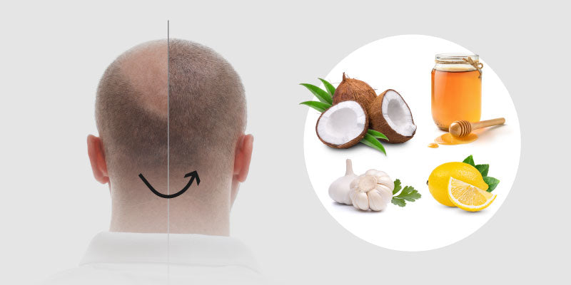 Alopecia baldness hair loss hair fall treatment. Best for hair growth Haestic